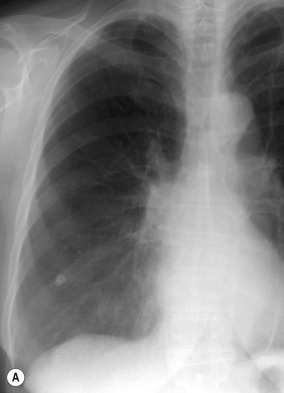 Fig. 7.3, Shifting Granuloma Sign.