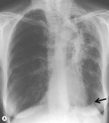 Fig. 7.5, Juxtaphrenic Peak Sign.