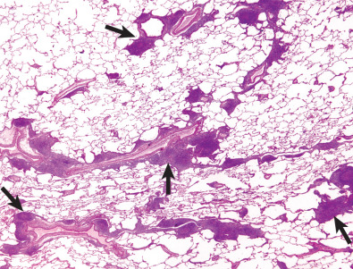 Fig. 23.1, Pulmonary lymphoid hyperplasia in a patient with rheumatoid arthritis: pathologic findings. Low-power view shows hyperplastic lymphoid follicles (arrows) along the bronchovascular bundles.