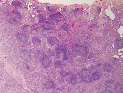 Fig. 23.2, Pulmonary lymphoid hyperplasia: pathologic findings. Histologic specimen shows extensive lymphoid hyperplasia with lymphoid nodules, including lymphoid follicles, adjacent to small airways.