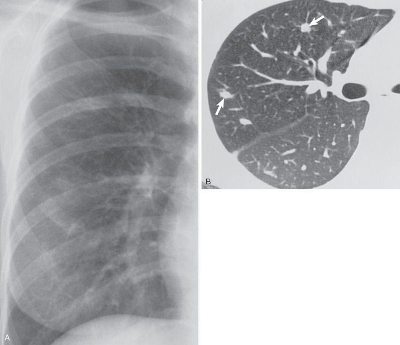 Fig. 23.3, Pulmonary lymphoid hyperplasia in rheumatoid arthritis. (A) View of the right lung from posteroanterior chest radiograph shows ill-defined nodular opacities. A similar pattern was present in the left lung. (B) High-resolution CT scan targeted to the right lung shows sharply defined peribronchovascular nodular opacities (arrows) in the right upper lobe.