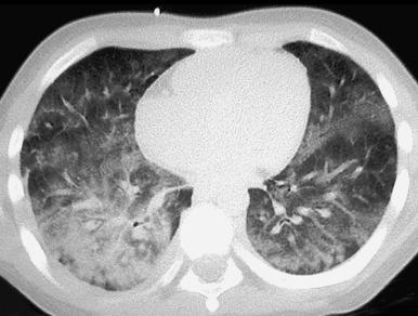 e-Figure 57.1, Pulmonary hemorrhage in a teenage boy with pulmonary vasculitis resulting from collagen vascular disease.