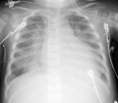 e-Figure 57.11, Dilated cardiomyopathy.