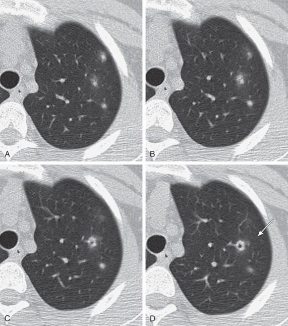 Figure 57.2, Granulomatosis with polyangiitis (Wegener).