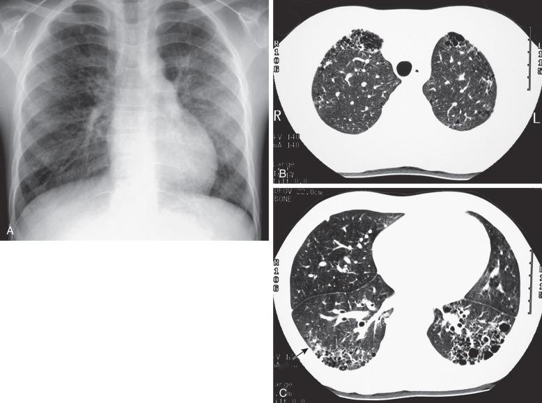 Figure 57.3, Systemic sclerosis (scleroderma) in an 8-year-old girl diagnosed at age 5 years.