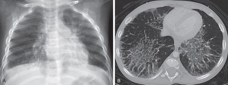 e-Figure 57.4, Systemic juvenile idiopathic arthritis and acute exacerbation in a 2-year-old.