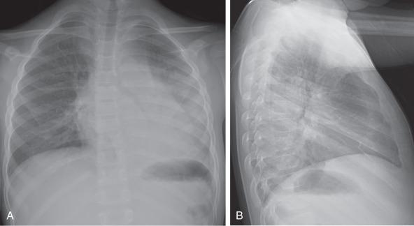 e-Figure 57.5, Sickle cell disease with acute chest syndrome.