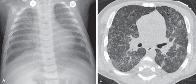 Figure 57.6, Langerhans cell histiocytosis of the lungs in a 2.5-month-old boy who initially presented with a skin rash.