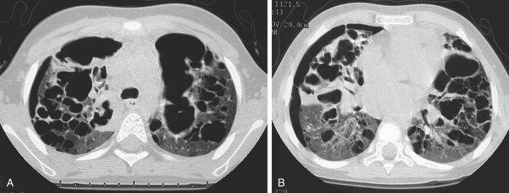 e-Figure 57.7, Progressive advanced changes in Langerhans cell histiocytosis (LCH) of the lungs.