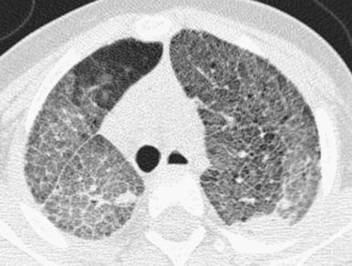 e-Figure 57.9, Niemann–Pick disease type C2.