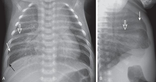 Figure 57.10, Pulmonary edema caused by obstructed pulmonary venous return (cor triatriatum).