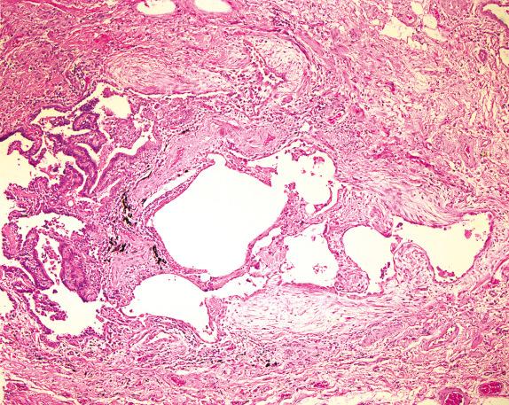 FIG. 35.1, Usual interstitial pneumonia pattern in rheumatoid arthritis. The usual interstitial pneumonia pattern displays dense interstitial fibrosis with fibroblast foci, mild interstitial mononuclear infiltrates, metaplastic epithelium, and honeycomb change.