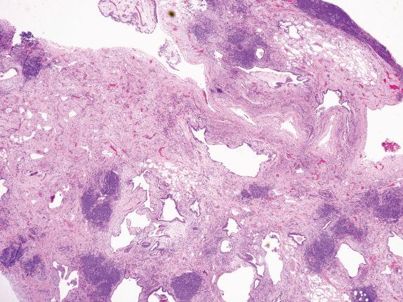 FIG. 35.2, Usual interstitial pneumonia pattern with lymphoid aggregates and lymphocytic pleuritis in rheumatoid arthritis. The usual interstitial pneumonia pattern of connective tissue disease–associated ILD is frequently accompanied by inflammation with prominent lymphoid aggregates and lymphocytic pleuritis.