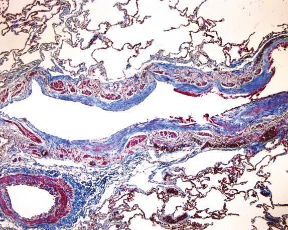 FIG. 35.4, Constrictive (obliterative) bronchiolitis in rheumatoid arthritis. Dense subepithelial collagen deposition produces narrowing of the airway lumen (Masson trichrome stain).