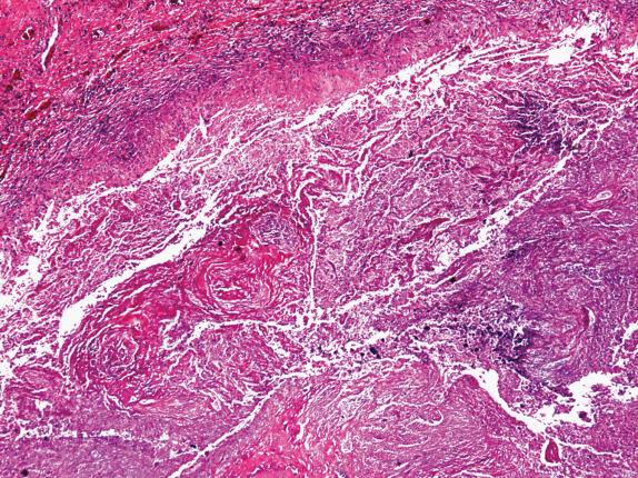 FIG. 35.5, Rheumatoid nodule. Necrobiotic nodule with central necrosis, surrounded by a border of histiocytes, and prominent lymphocytic infiltrates in the periphery.