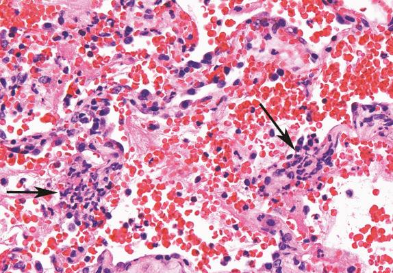 FIG. 35.6, Small-vessel vasculitis. In a background of hemorrhage, alveolar septa are focally permeated by neutrophils (arrows). There is adjacent septal necrosis.