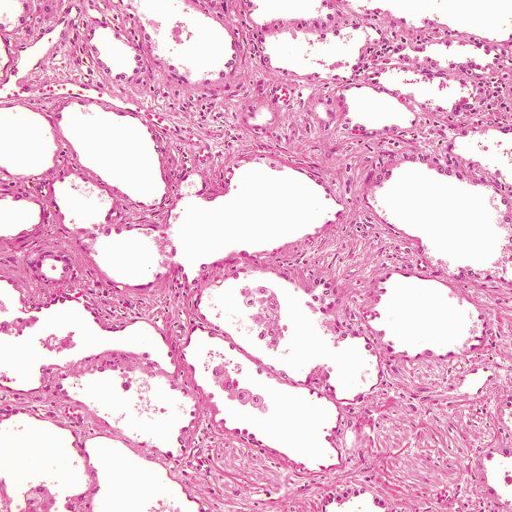 FIG. 35.7, Nonspecific interstitial pneumonia, fibrosing pattern. Alveolar septa are fibrotically thickened with preservation of alveolar architecture.