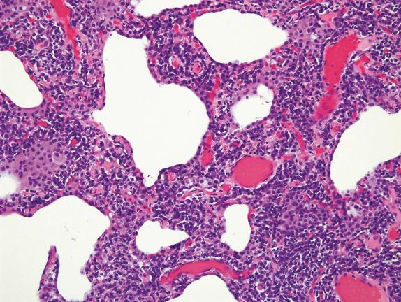 FIG. 35.8, Lymphoid interstitial pneumonia. Dense infiltrates of lymphocytes and plasma cells expand alveolar septa.