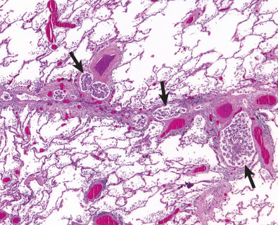 Fig. 22.1, Lymphangitic carcinomatosis: pathologic findings. Pathologic specimen shows thickening of interlobular septum by edema and focal accumulations of tumor cells (arrows) within dilated lymphatics.