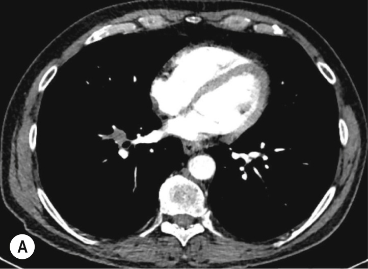 Axial image from a contrast enhanced CT and CT image, FDG PET image and fused image from a CT PET study, demonstrating a PET positive right lung nodule. (A) Lung nodule close to the right hilum with (B) increased uptake on PET/CT corresponding to lung cancer. **