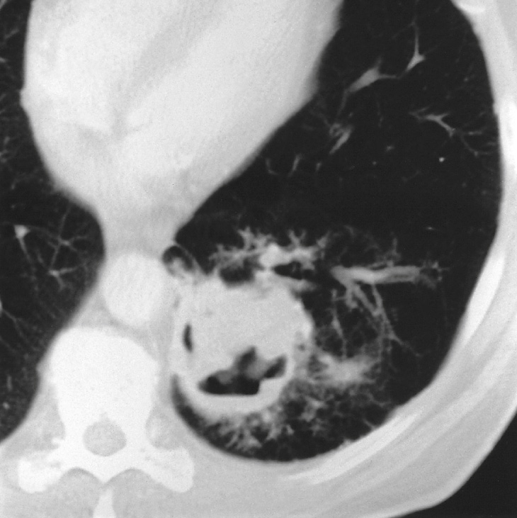 Cavitating squamous cell carcinoma. CT – the wall of the cavity is variable in thickness. *