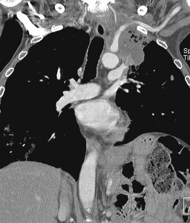 Pancoast's tumour. Coronal CT demonstrating a large tumour in the left upper lobe invading the soft tissues, displacing and invading the left subclavian artery. *