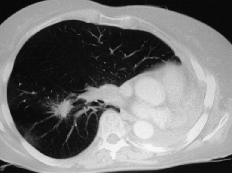 CT demonstrating a second primary bronchogenic carcinoma in the right lung in a patient who had undergone a previous left pneumonectomy. The new tumour has spiculated edges infiltrating into the adjacent lung (corona radiata). *