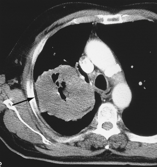 Cavitating bronchogenic carcinoma. There is preservation of the extrapleural fat plane at the point of contact with the chest wall (arrow). Although the pleura may be involved, the chest wall is likely to be otherwise spared. *