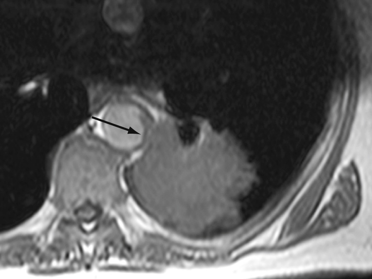 MRI of a left lower lobe tumour that has directly invaded the aortic wall, which has altered the signal adjacent to the tumour (arrow). *