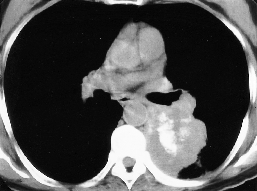 Tumour calcification. Large bronchial carcinoma within the left lower lobe showing extensive amorphous and cloud-like calcification. *