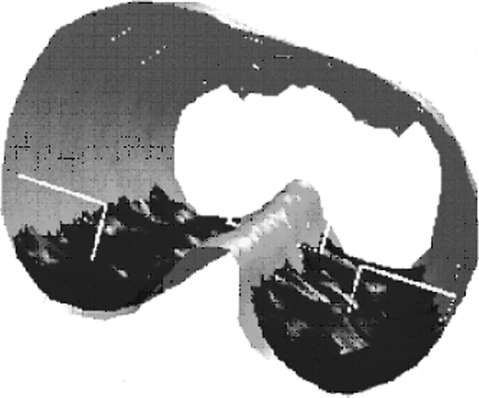 Fig. 9.2, Three-dimensional reconstruction of chest computed tomographic scans in an anesthetized and paralyzed human.