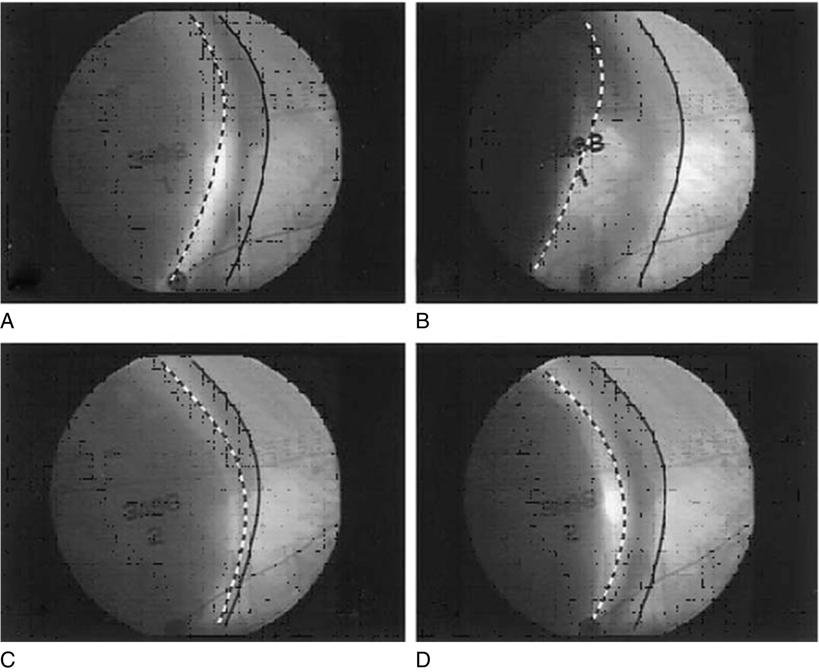 Fig. 9.3, Lateral views of the diaphragm at end inspiration (stippled line) and at end expiration (thick line) in a healthy subject during spontaneous breathing (A and B) and during mechanical ventilation (C and D). The area between the two lines represents diaphragm excursion. Inspirations with baseline tidal volumes (A and C) and with large tidal volumes (B and D) are shown. Overall diaphragm excursion was reduced during mechanical ventilation at both tidal volumes. The posterior (inferior parts of the pictures) portion of the diaphragm had the greatest reduction in tidal excursion.