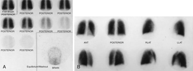 Figure 79-1, Normal V/Q scan. A, 133 Xe ventilation scan showing uniform radiotracer activity in lungs on initial first breath image ( first image on upper left ), followed by equilibrium phase images, and then washout phase images (obtained every 45 seconds). B, 99m Tc-MAA perfusion scan images are shown in multiple projections (top row: anterior, posterior, right lateral, and left lateral projections; bottom row: left posterior oblique, right posterior oblique, right anterior oblique, and left anterior oblique projections) that also demonstrate uniform radiotracer activity throughout both lungs. A brain image ( below ventilation scan images ) is obtained to observe whether there is any right-to-left shunting of 99m Tc-MAA.