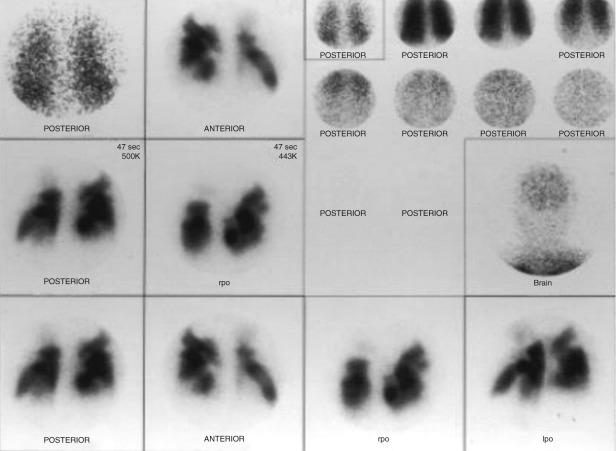 Figure 79-2, “PE present” on V/Q scan. Note relatively uniform ventilation of lungs ( top row in upper right corner ) with only mild gas trapping seen in upper lobes on washout phase images ( bottom row in upper right corner ). Multiple wedge-shaped perfusion defects throughout both lungs are also present that are mismatched (i.e., without corresponding ventilation defects). Also note mild 99m Tc-MAA uptake in brain consistent with presence of right-to-left shunt.