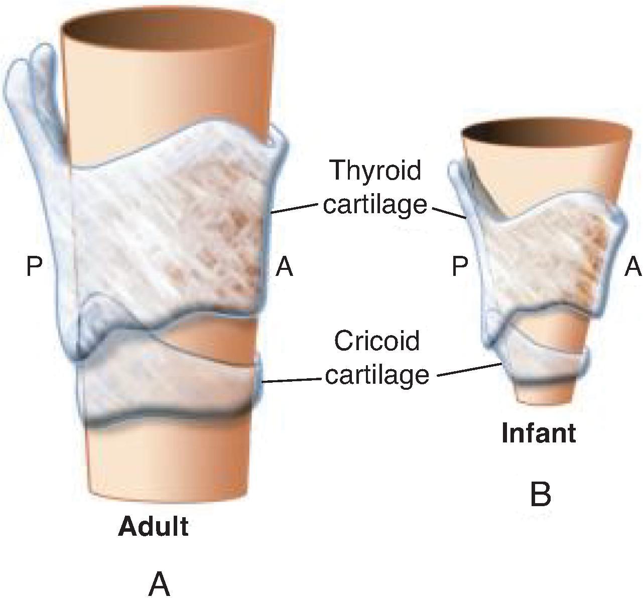 Fig. 84.1, Anatomic Differences Between the Adult (A) and Infant (B) Larynx .