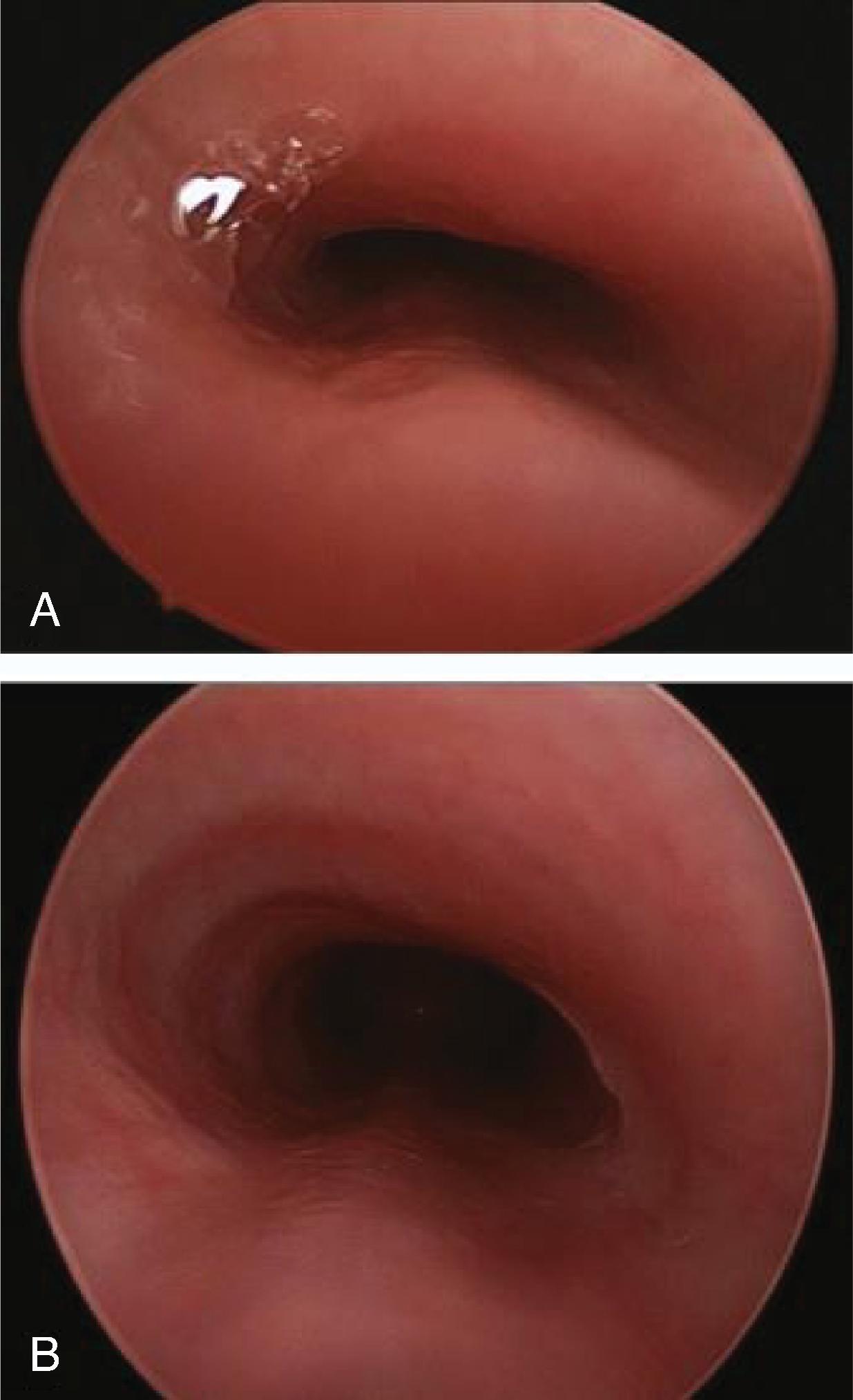 Fig. 84.2, Secondary Tracheomalacia Caused by Innominate Artery Compression .