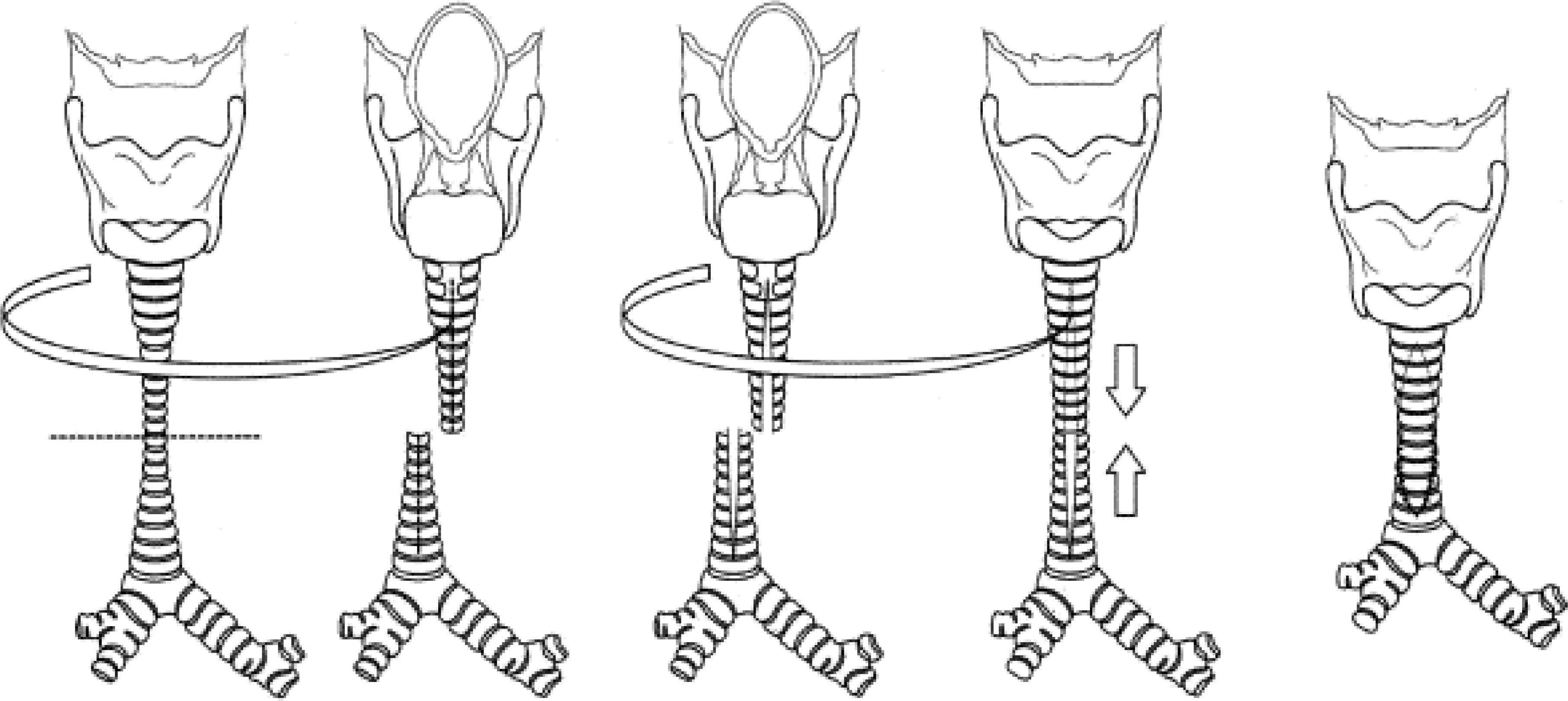 Fig. 84.3, Slide Tracheoplasty Technique .