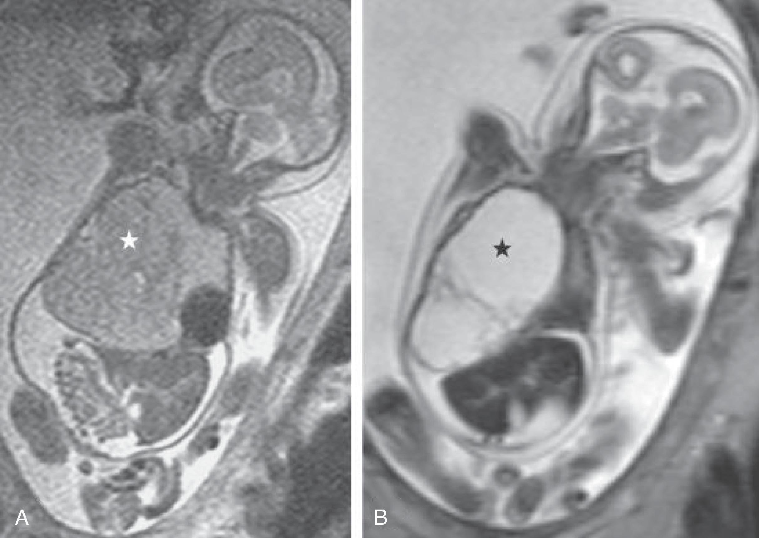 Fig. 84.4, Fetal Magnetic Resonance Imaging Showing a Microcystic Congenital Lung Lesion .