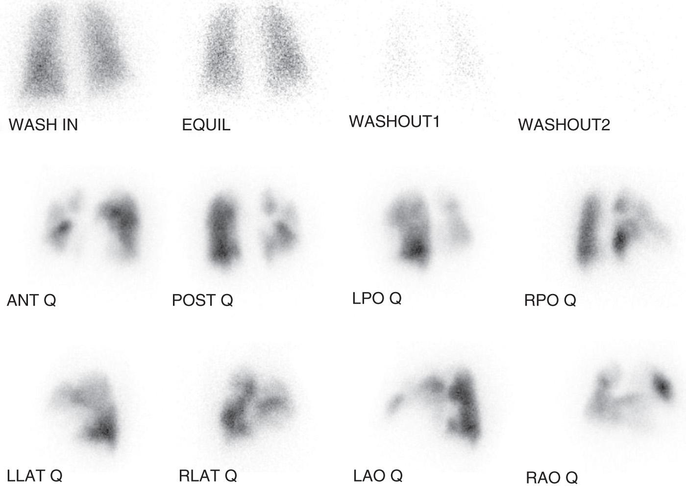 Fig. 20.1, Lung ventilation-perfusion scan. Unmatched perfusion abnormalities include “hypoperfused” left upper lobe, with scattered segmental perfusion defects in the lingula and throughout the right lung. ANT, Anterior; EQUIL, equilibrium; LAO, left anterior oblique; LLAT, left lateral; LPO, left posterior oblique; POST, posterior; Q, perfusion; RAO, right anterior oblique; RLAT, right lateral; RPO, right posterior oblique.