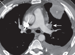 FIGURE 21.1, Lung cancer and asbestos exposure. Computed tomography image shows left upper lung cancer (T) with right anterior calcified pleural plaques (long arrow) . Note left hilar adenopathy (short arrow) and small left pleural effusion.