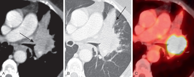 FIGURE 21.11, Squamous cell lung cancer. Computed tomography (CT) (A) shows a partially necrotic central left upper lobe mass with cut-off of the left upper lobe bronchus (arrow) and (B) associated wedge-shaped postobstructive atelectasis (arrow) . Positron emission tomography/CT (C) is useful in delineating the primary tumor from the adjacent atelectasis.