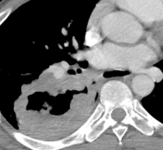 FIGURE 21.12, Squamous cell lung cancer. Computed tomography image shows a large cavitary mass in the right lower lobe consistent with squamous cell lung cancer.