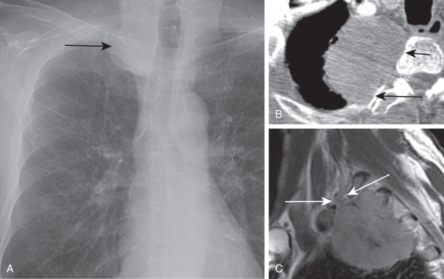 FIGURE 21.13, Pancoast tumor. A, Frontal chest radiograph shows right apical mass (arrow) . B, Computed tomography image shows the right superior sulcus tumor invading the right posterior third rib (long arrow) and right lateral aspect of the T3 vertebra (short arrow) . C, Sagittal T1-weighted non–contrast-enhanced magnetic resonance image of the brachial plexus shows invasion of the chest wall fat and brachial plexus (arrows) .