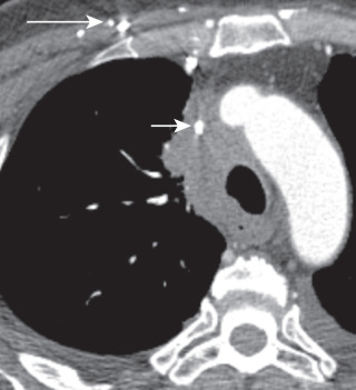 FIGURE 21.14, Small cell lung cancer with superior vena cava (SVC) syndrome. Computed tomography image shows bulky right paratracheal adenopathy encasing and narrowing the SVC (short arrow) and multiple collaterals in the right anterior chest wall (long arrow).