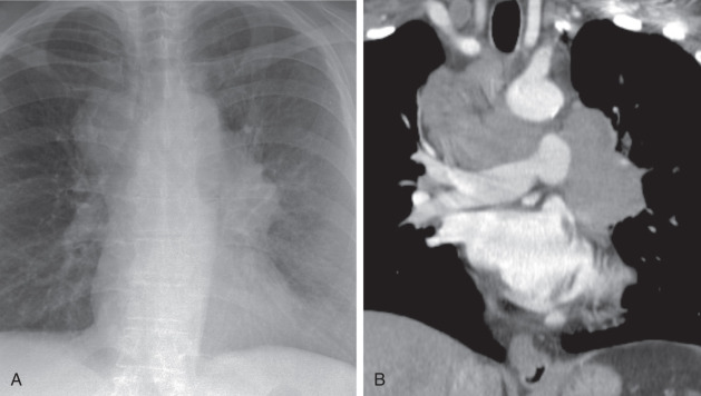 FIGURE 21.15, Small cell lung cancer. Frontal radiograph (A) and coronal contrast-enhanced computed tomography (B) images show left upper lobe central mass with bulky mediastinal adenopathy. Biopsy showed small cell lung cancer.