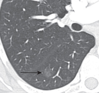 FIGURE 21.4, Adenocarcinoma in situ (AIS). Computed tomography (CT) image shows a 2-cm pure ground-glass nodule in the right lower lobe (arrow) , and surgical pathology showed AIS. Note that atypical adenomatous hyperplasia (AAH) and AIS are pathologic entities considered to be part of a spectrum and cannot be differentiated on cytology. The differentiation of AAH and AIS is not possible on CT when the lesion is a small pure ground-glass nodule.