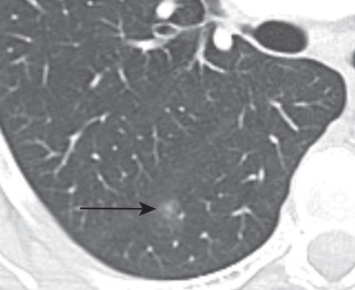 FIGURE 21.5, Minimally invasive adenocarcinoma (MIA). Computed tomography image shows 1-cm ground-glass nodule (arrow) in the right lower lobe with a soft tissue component measuring less than 3 mm consistent with MIA.