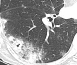 FIGURE 21.8, Adenocarcinoma as consolidative opacity. Computed tomography image shows area of consolidation in the periphery of the right lower lobe consistent with adenocarcinoma.