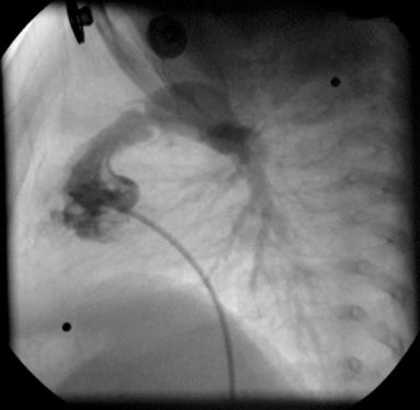 Fig. 56.1, Angiography of the right ventricular outflow tract in a neonate with critical pulmonary stenosis.