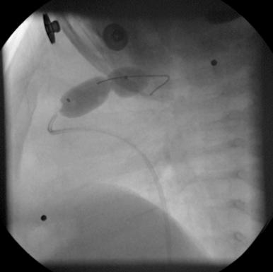 Fig. 56.2, Balloon inflation in a favored position with the stenotic pulmonary valve resting at the midpoint of the balloon.